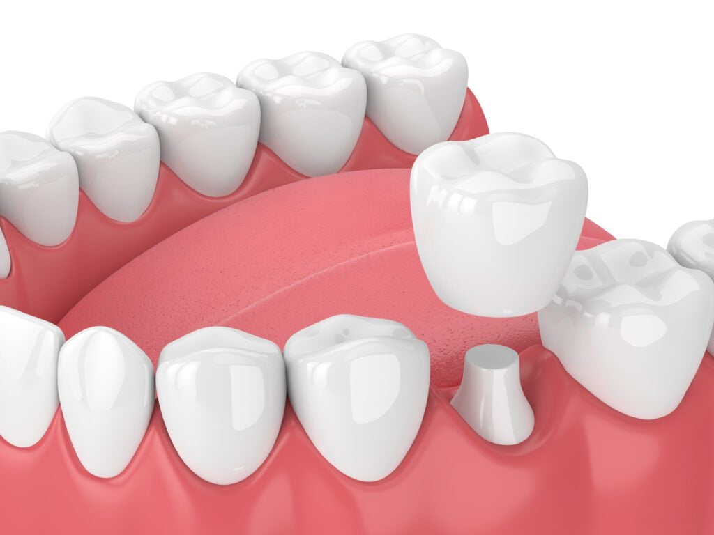dental crowns Milford