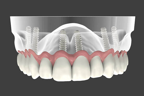 Implant supported denture graphic